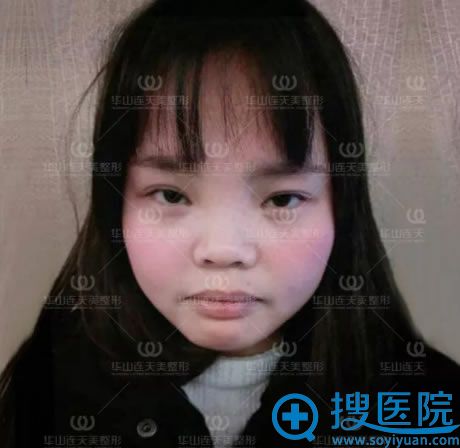 安琪做鼻子之前的下面照 安琪做鼻子之前的下面照