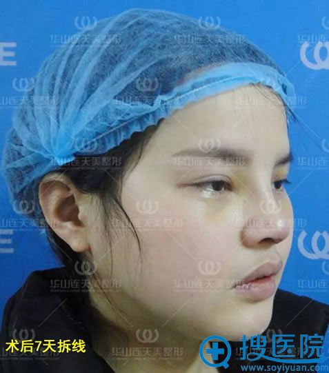 隆鼻术后7天拆线照片 隆鼻术后7天拆线照片