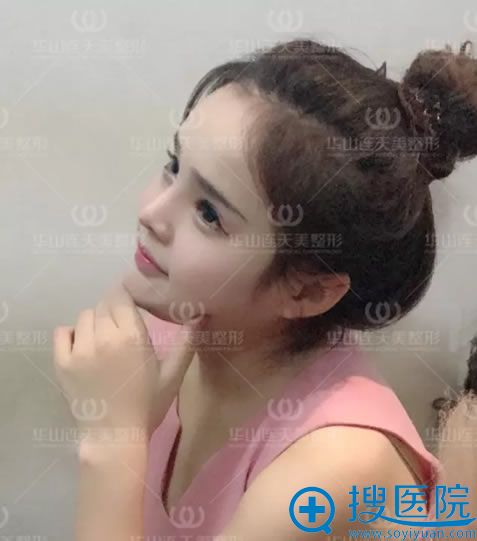 安琪隆鼻手术第20天照片 安琪隆鼻手术第20天照片