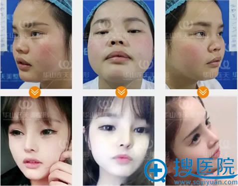 安琪做隆鼻手术前后效果对比图 安琪做隆鼻手术前后效果对比图