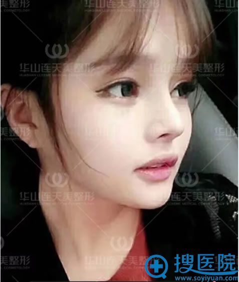 华山连天美<!--<i data=20240710 data-id=16495></i>-->隆鼻效果好不好 华山连天美<!--<i data=20240710 data-id=16495></i>-->隆鼻效果好不好
