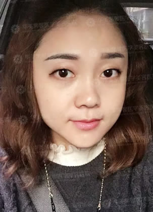 成都去眼袋好的医院?华美紫馨邱伟医生祛眼袋手术案例全过程