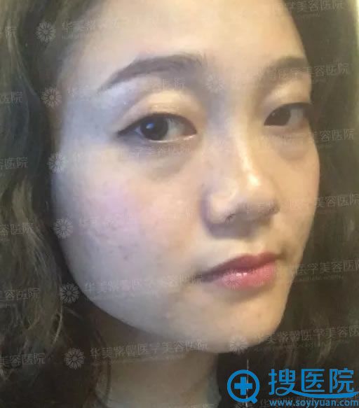 祛眼袋手术前的侧面照片 祛眼袋手术前的侧面照片