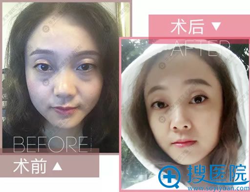 做眼袋手术前后对比照片 做眼袋手术前后对比照片