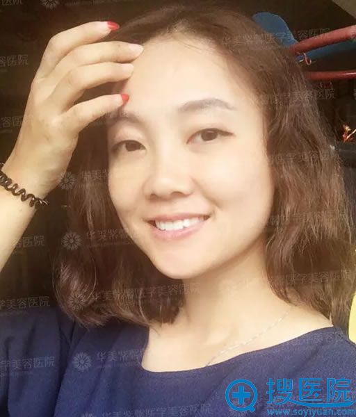 华美紫馨祛眼袋手术第5天效果 华美紫馨祛眼袋手术第5天效果