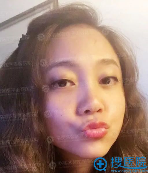 在华美紫馨做眼袋的第35天 在华美紫馨做眼袋的第35天