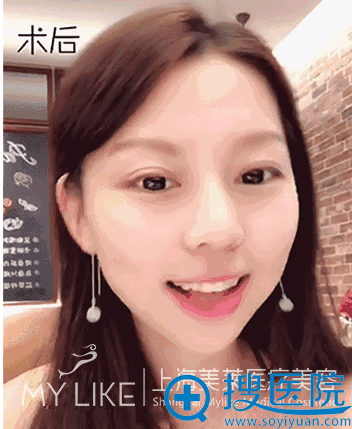 真实双眼皮+开眼角案例为你揭秘上海美莱杜园园做眼睛怎么样