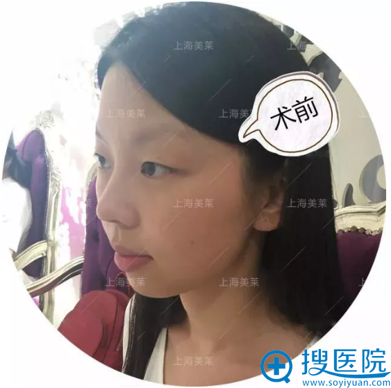 术前照片 术前照片