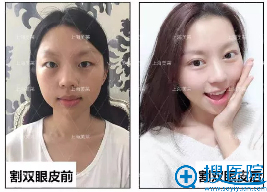 杜园园双眼皮案例前后对比图 杜园园双眼皮案例前后对比图