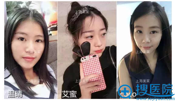 上海美莱双眼皮案例组 上海美莱双眼皮案例组