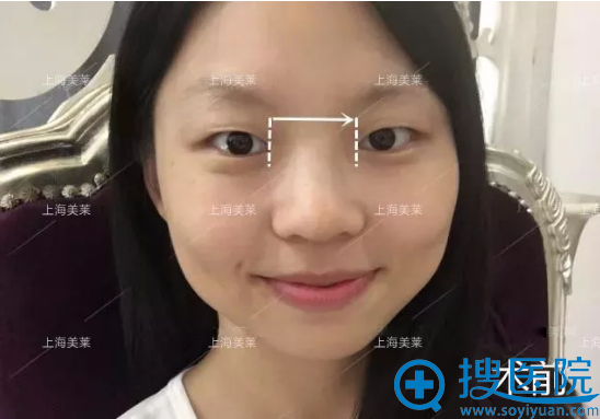 双眼皮术前分析 双眼皮术前分析