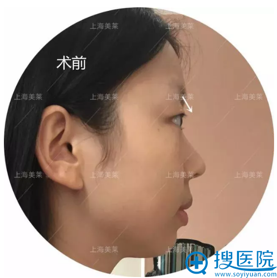 术前侧面照片 术前侧面照片