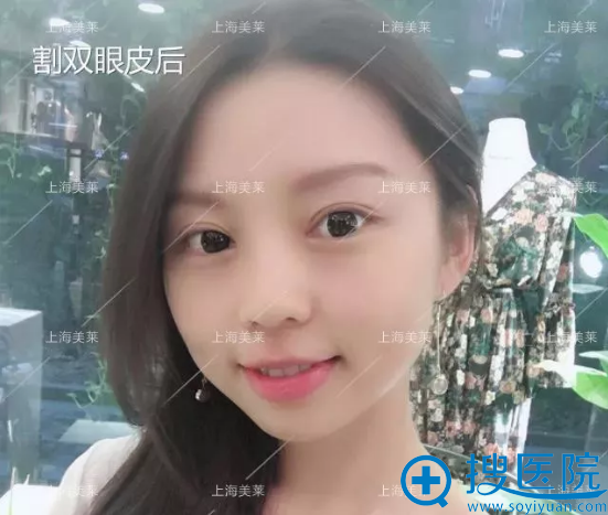 双眼皮术后生活照 双眼皮术后生活照