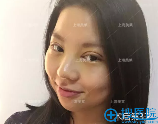 找上海美莱杜园园做双眼皮3天效果 找上海美莱杜园园做双眼皮3天效果