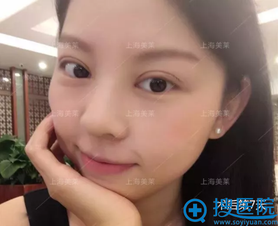 切开双眼皮术后7天自拍 切开双眼皮术后7天自拍