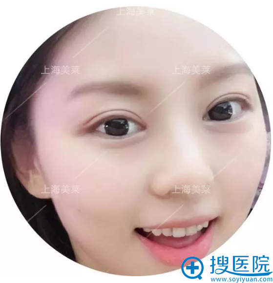 双眼皮半个月了,好漂亮 双眼皮半个月了,好漂亮