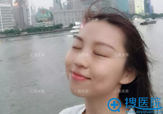 杜园园双眼皮案例30天闭眼效果。 杜园园双眼皮案例30天闭眼效果。