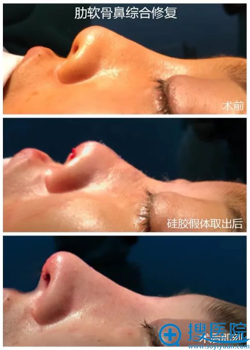 做完鼻综合修复手术即刻效果图 做完鼻综合修复手术即刻效果图