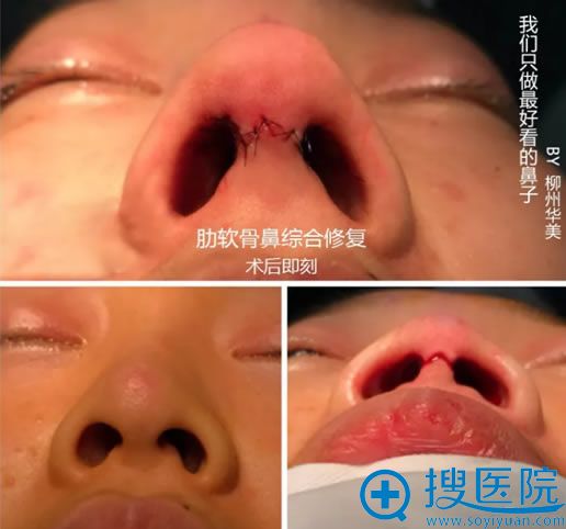 假体隆鼻失败修复手术正面照片 假体隆鼻失败修复手术正面照片