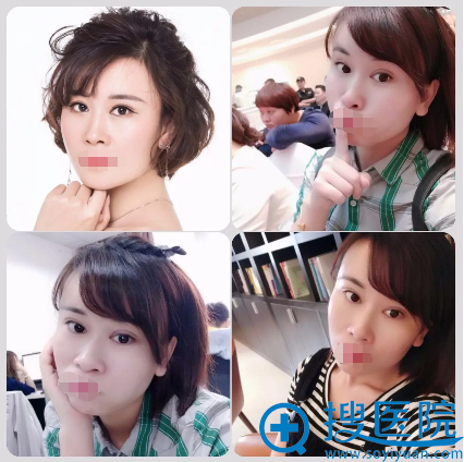 眼综合+自体脂肪填充+手术一个月恢复照片 眼综合+自体脂肪填充+手术一个月恢复照片