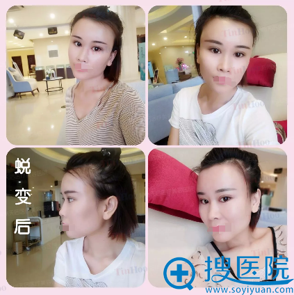 <!--<i data=20240710 data-id=12037></i>-->眼综合+自体脂肪填充半个月恢复效果 <!--<i data=20240710 data-id=12037></i>-->眼综合+自体脂肪填充半个月恢复效果