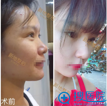 合肥新地整形医院隆鼻真实体验 术后对比及恢复期照片大分享
