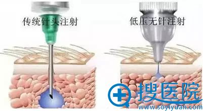 无针水光和的原理不同 无针水光和的原理不同