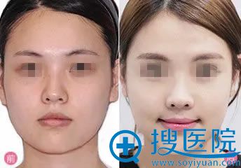玉之光无针水光美肤案例图 玉之光无针水光美肤案例图