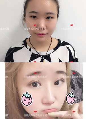 贵阳美莱李信锋隆鼻案例之东方黄金三角鼻雕前后对比效果