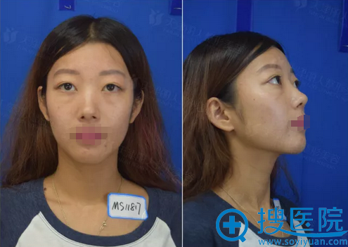 天津丽人整形医院假体隆鼻+鼻翼缩小真人案例对比照片分享