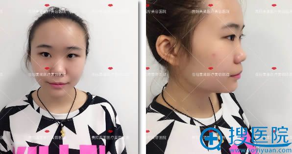 在贵阳美莱做隆鼻前的样子 在贵阳美莱做隆鼻前的样子