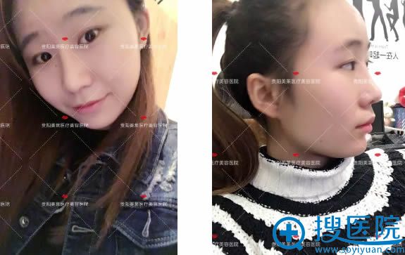 李信锋医生隆鼻术后20天恢复效果 李信锋医生隆鼻术后20天恢复效果