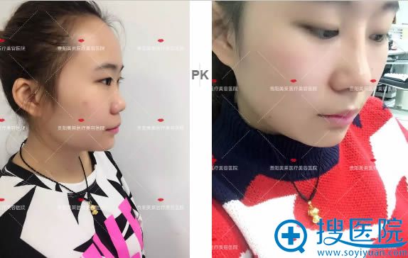 李信锋做鼻子案例对比图片 李信锋做鼻子案例对比图片