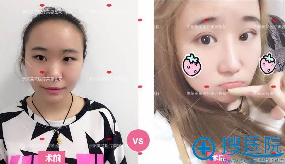 双眼皮术后前后对比图 双眼皮术后前后对比图