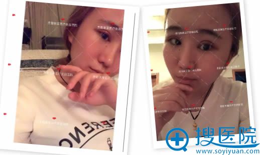 做完双眼皮术后3天的美照 做完双眼皮术后3天的美照