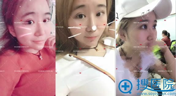 美莱急速纳米电眼术后5天的恢复照 美莱急速纳米电眼术后5天的恢复照
