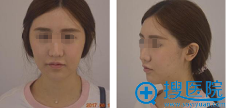 武汉洪山爱美汇瞿敏医生面部吸脂瘦脸术后2个月恢复过程图分享