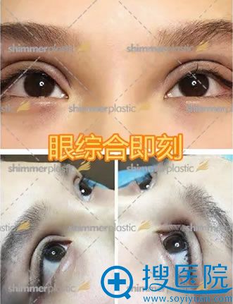 双眼皮手术肿胀期效果图 双眼皮手术肿胀期效果图