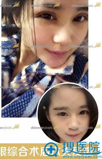 双眼皮手术第6天快消期照片 双眼皮手术第6天快消期照片