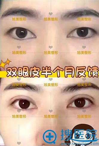 双眼皮手术15天的效果图 双眼皮手术15天的效果图