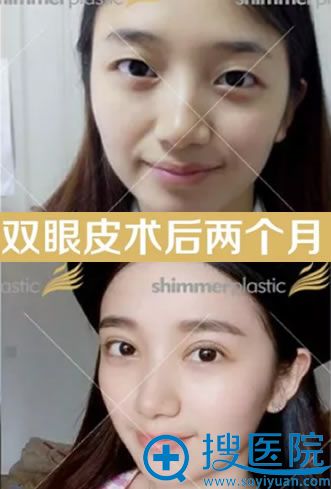 双眼皮手术两个月恢复照片 双眼皮手术两个月恢复照片