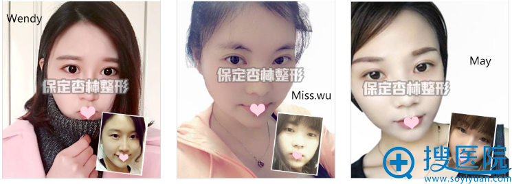 <!--<i data=20240710 data-id=12345></i>-->整形医院丛相文双眼皮案例 <!--<i data=20240710 data-id=12345></i>-->整形医院丛相文双眼皮案例