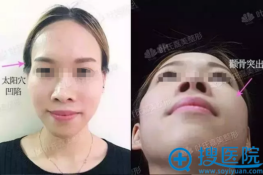 桂林叶氏嘉美自体脂肪填充效果好不好?真人案例为你揭秘