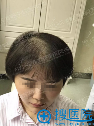 四川哪里植发好?看四川美莱微针植发真人案例术后30天恢复效果