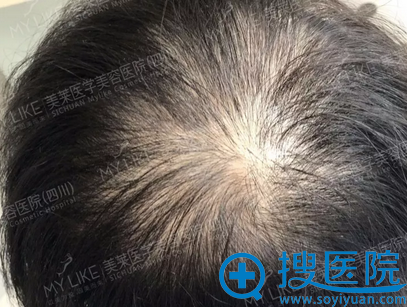 植发前头顶细节图 植发前头顶细节图