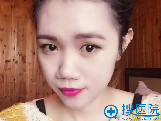 泉州海峡医院隆鼻好不好?郭永军院长鼻综合案例效果图分享