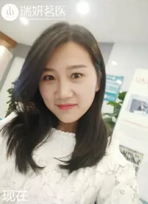 90后小美女亲身体验北京瑞妍茗医舒敏之星治疗敏感肌3个月效果