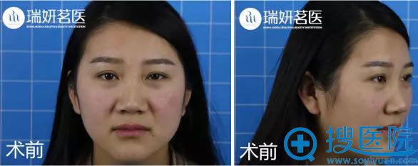 小白做敏感肌治疗前照片 小白做敏感肌治疗前照片