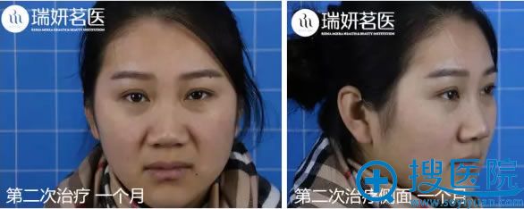 90后美女体验敏感肌治疗1个月效果 90后美女体验敏感肌治疗1个月效果