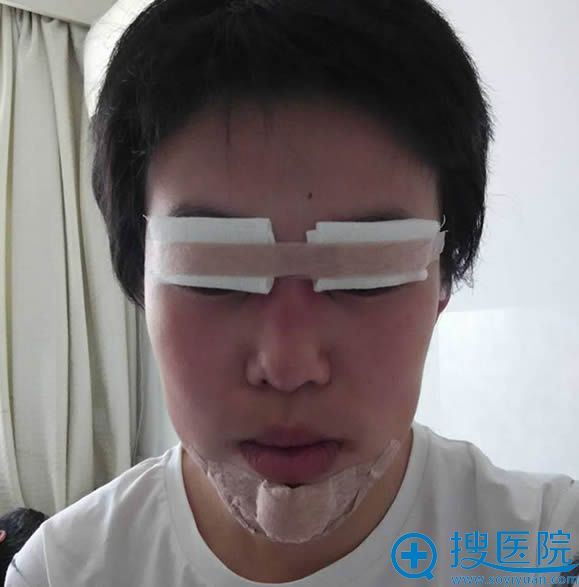 刚完做双眼皮术后的照片 刚完做双眼皮术后的照片